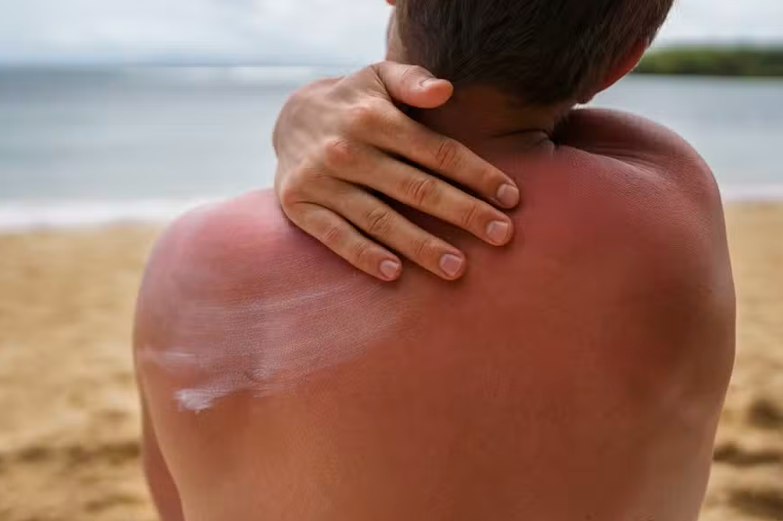 Dezembro Laranja: Tudo o que você precisa saber sobre o câncer de pele